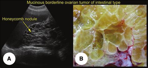 Mucinous borderline tumor of intestinal type (transabdominal scan ...