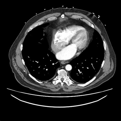 Occluded SMA