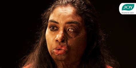 JOY Personal Care empowers acid attack survivors with new campaign