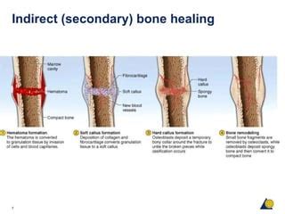 Fracture healing