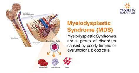 Myelodysplastic Syndrome