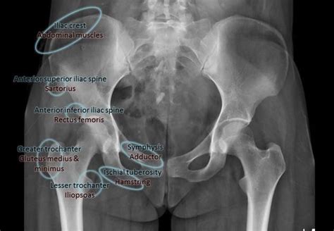 Apophyseal avulsion fractures are usually the result of a sudden ...