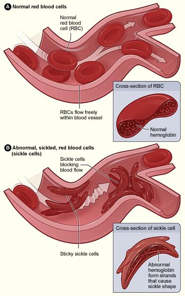 Anemia falciforme - Sickle cell disease - qaz.wiki