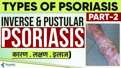 Inverse And Pustular Psoriasis Treatment at Home | Inverse Psoriasis ...