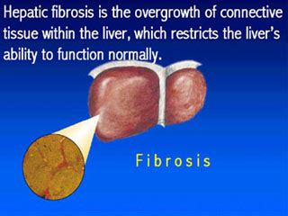 HBsAg Levels Linked with Fibrosis in HBeAg-Positive Patients ...