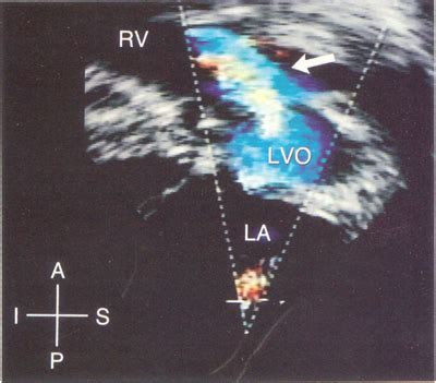 Double outlet right ventricle - wikidoc