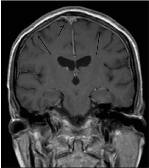 Waldenström's macroglobulinemia MRI - wikidoc