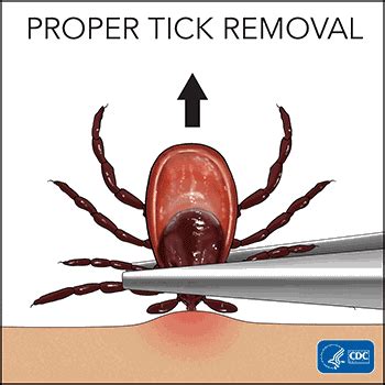 Preventing and Removing Ticks