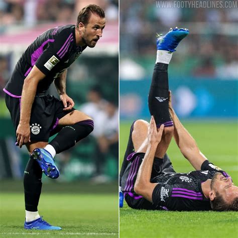 Harry Kane Had Blisters On Both Feet Wearing Skechers Football Boots ...