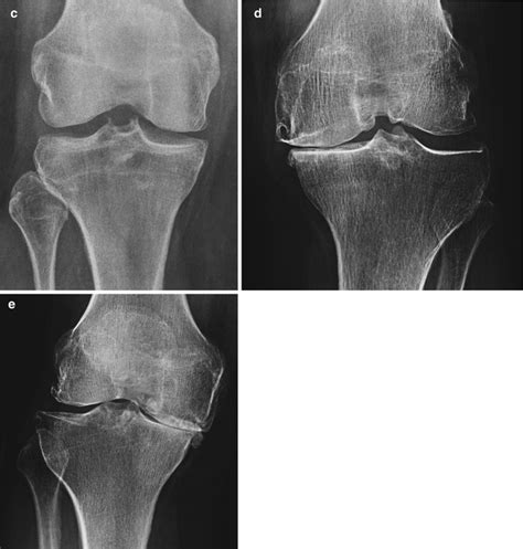 Acetabular Osteophytic Lipping | Ownerlip.co