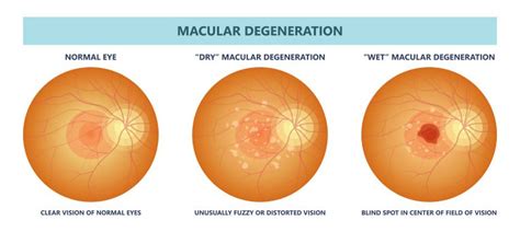 Wet Vs Dry Macular Degeneration: Understand The Differences