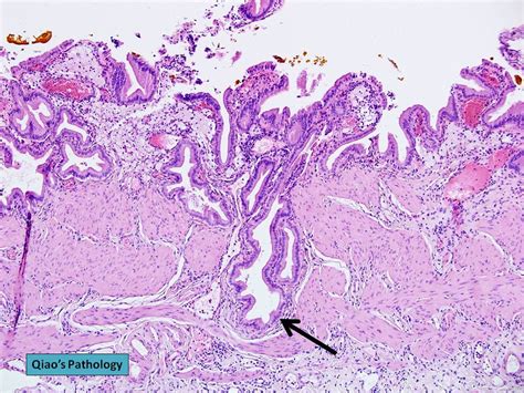 Rokitansky Aschoff Sinuses Gallbladder - Wall Changes - Sonographic ...