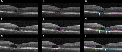 Optical Coherence Tomographic Features Of Macular, 59% OFF