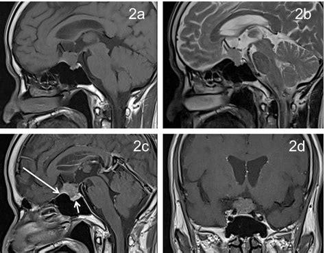 Suprasellar meningioma – Radiology Cases