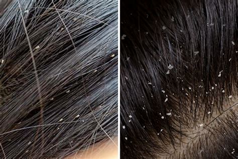 Lice vs Dandruff: A Detailed Comparison - Blog Eternal