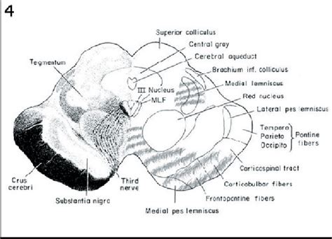 Figure 3 from Weber's syndrome and sixth nerve palsy secondary to decompression illness: a case ...