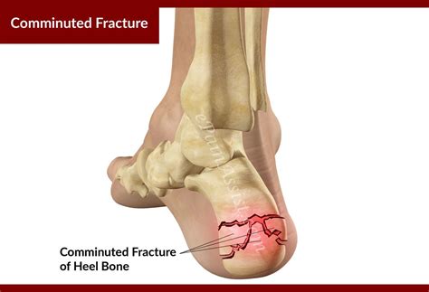 Comminuted Fracture of the Calcaneus or Heel Bone | Calcaneus fracture, Heel treatment ...