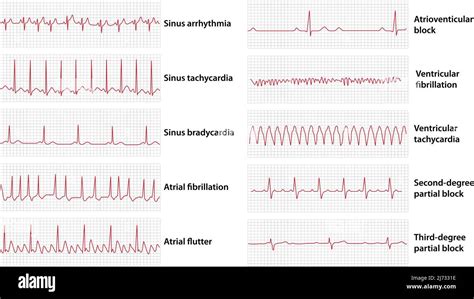 Schemes set of common electrocardiogram (ECG) abnormalities, including partial blocks and ...