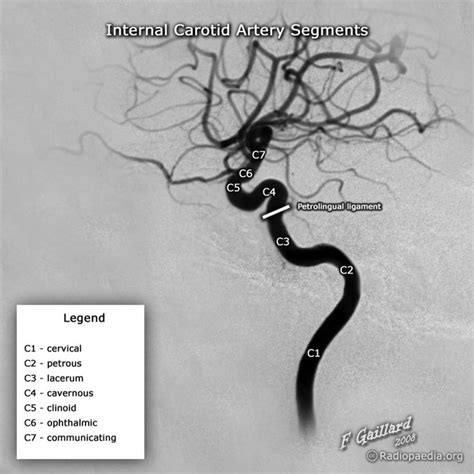 صورة ذات صلة | Internal carotid artery, Carotid artery, Radiology