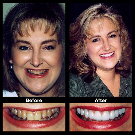 Discolored Teeth Stain Removal | Oppenheim Signature Smiles