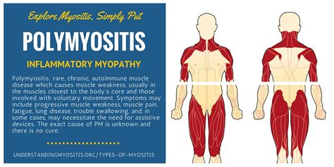 Polymyositis is a rare autoimmune disease - Myositis Support and Understanding