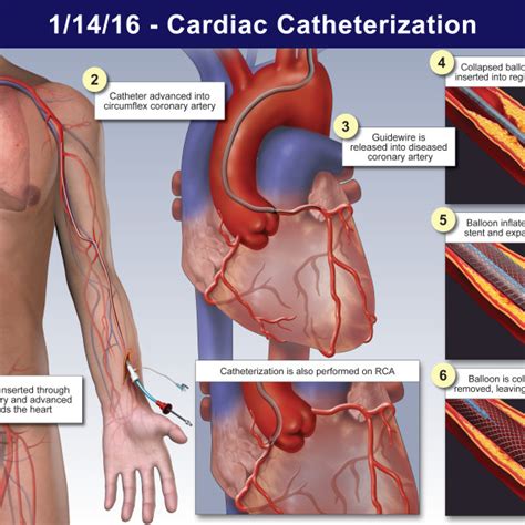 Cardiac Catheterization - TrialQuest Inc.