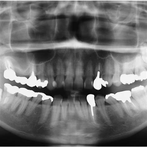 Perioperative photo and histology of the coronoid process. Anterior ...