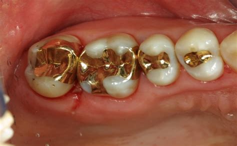 Gold-dental-fillings - ADDC Dental Alexander Drive Dental Clinic