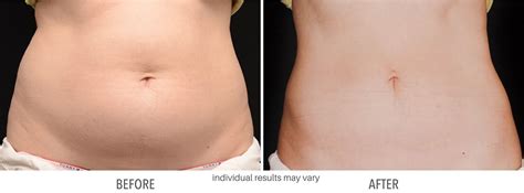 CoolSculpting Before and After | Fat Freezing Body Transformations