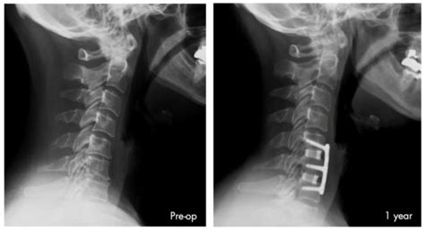 Two Level ACDF Using Silicon Nitride (Si3N4) Implants Review - Sintx