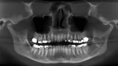 Odontogenic Keratocyst Radiology