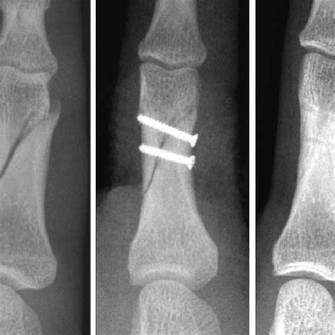 case 1: a simple oblique fracture of the proximal phalanx in the left ...