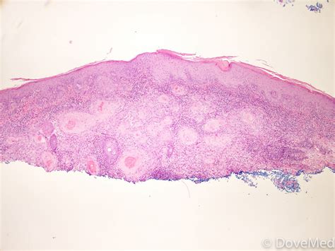 Metastatic Squamous Cell Carcinoma of Skin