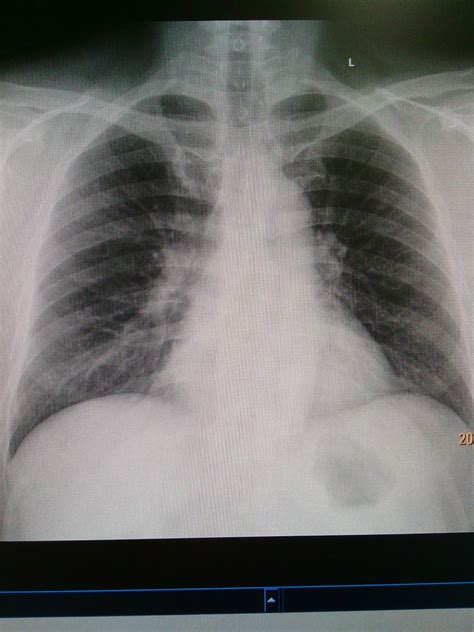 Chest X Ray Bronchitis - Radiology Imaging