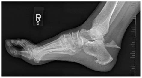 life after a calcaneus fracture surgery - Warner Partridge