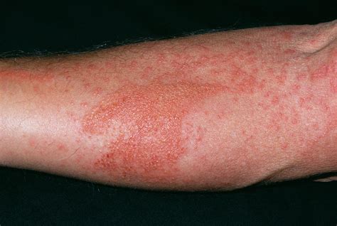 Nettle Rash Photograph by Dr P. Marazzi/science Photo Library