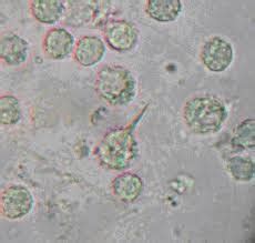 Saranyha creation: Review uric crystal in synovial fluid