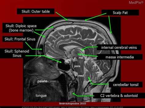 Cross Sectional Anatomy Mri Brain Sagittal Anatomy