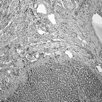 A change on the IV segment of the liver - hypodense lesion 29x31x35 mm... | Download Scientific ...