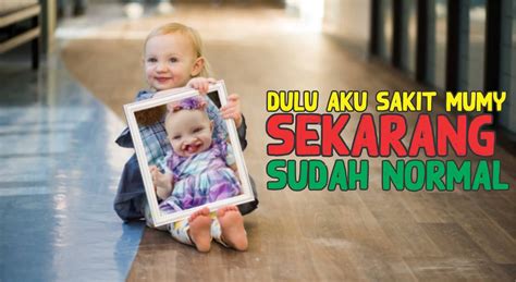 Bibir Sumbing pada Bayi - www.pustakasehat.com