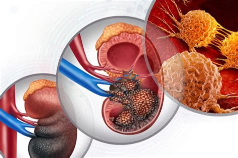 PRIME® Online Activity - Optimizing Treatment Sequencing for Advanced/Metastatic Renal Cell ...