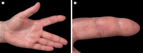 Response of Dystrophic Calcification to Intravenous Immunoglobulin | Dermatology | JAMA ...