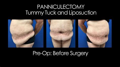 Panniculectomy Surgery: Tummy Tuck and Liposuction - YouTube