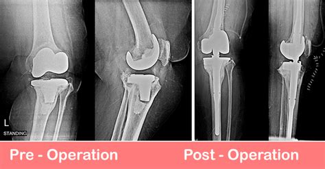 Revision Total Knee Replacement ( RHK) | Dr. Shekhar Agarwal