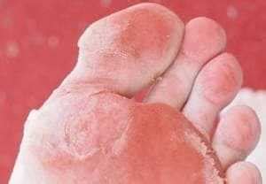 Excessive Dead Skin on Feet - Health Advisor