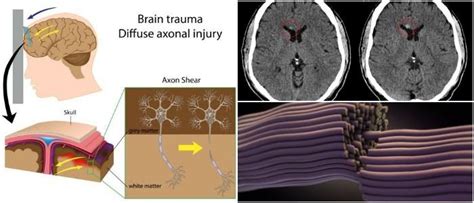 Diffuse Axonal Injury: Causes, Symptoms, Diagnosis, and Treatment - Hoool Health & Wellness