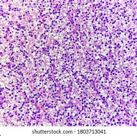 73 Parathyroid Histology Images, Stock Photos & Vectors | Shutterstock