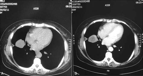 Pulmonary spindle cell carcinoma with unusual morphology: A... : Medicine