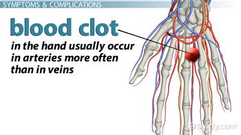 Blood Clot in the Hand: Symptoms, Signs & Treatment - Video & Lesson Transcript | Study.com