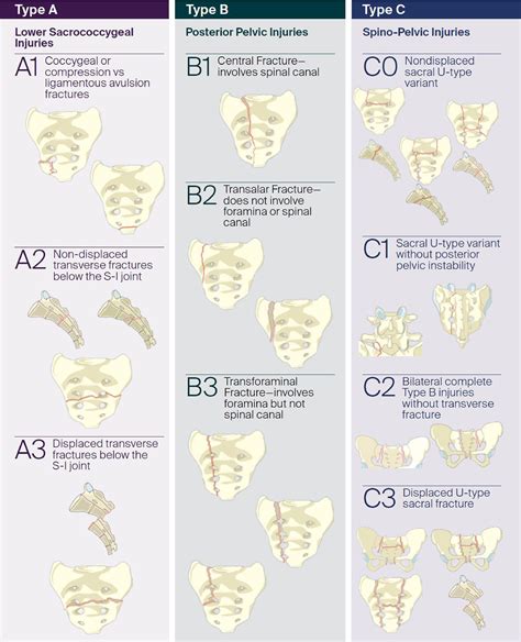 Inter- and intra-observer agreement using the new AOSpine sacral fracture classification, with a ...